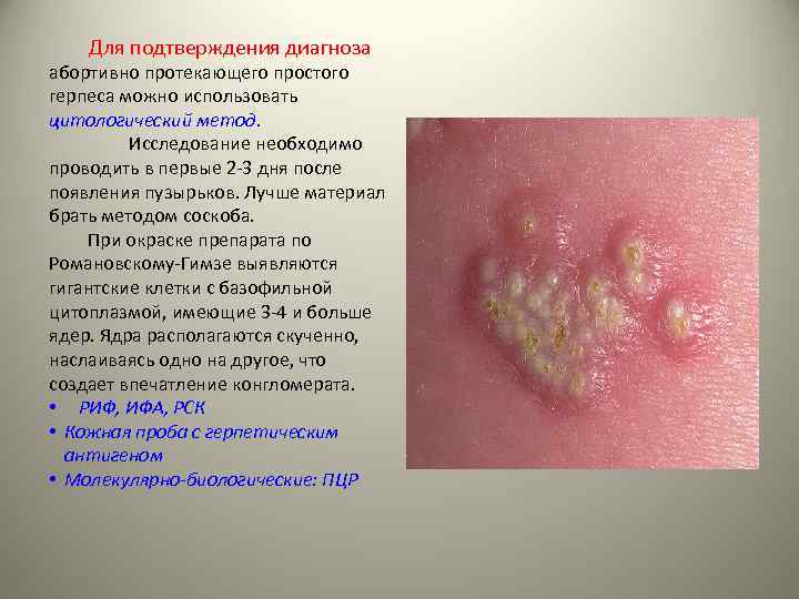 Для подтверждения диагноза абортивно протекающего простого герпеса можно использовать цитологический метод. Исследование необходимо проводить