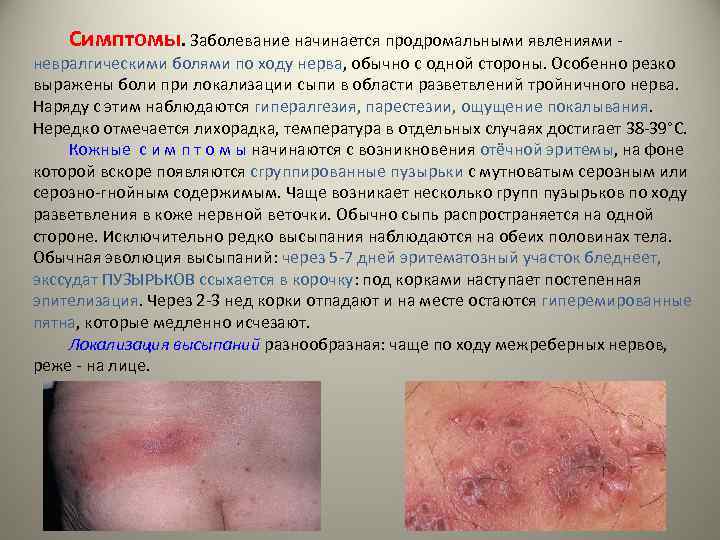 Симптомы. Заболевание начинается продромальными явлениями - невралгическими болями по ходу нерва, обычно с одной