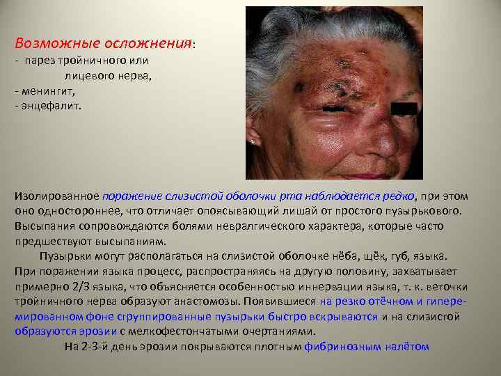Возможные осложнения: - парез тройничного или лицевого нерва, - менингит, - энцефалит. Изолированное поражение