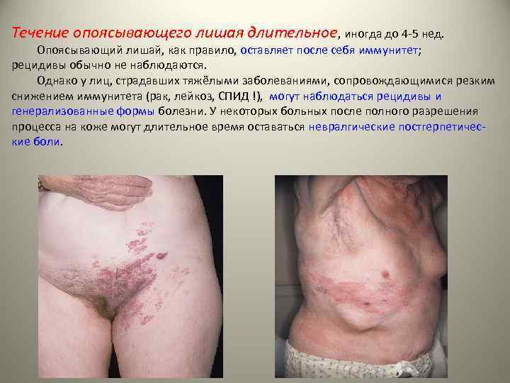 Течение опоясывающего лишая длительное, иногда до 4 -5 нед. Опоясывающий лишай, как правило, оставляет