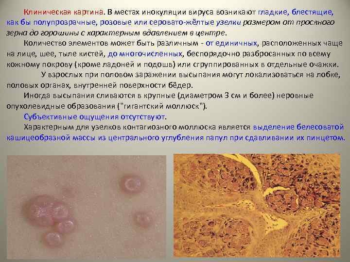 Клиническая картина. В местах инокуляции вируса возникают гладкие, блестящие, как бы полупрозрачные, розовые или