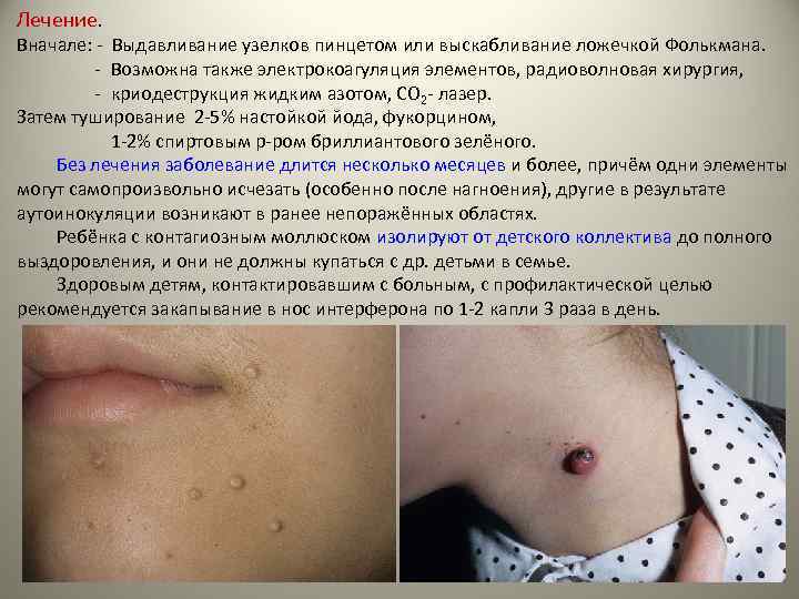 Лечение. Вначале: - Выдавливание узелков пинцетом или выскабливание ложечкой Фолькмана. - Возможна также электрокоагуляция