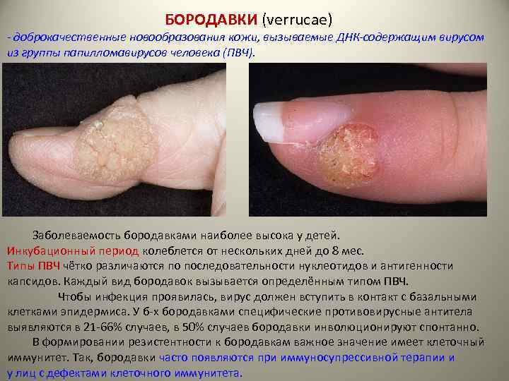 БОРОДАВКИ (verrucae) - доброкачественные новообразования кожи, вызываемые ДНК-содержащим вирусом из группы папилломавирусов человека (ПВЧ).