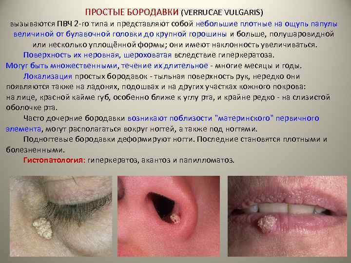 ПРОСТЫЕ БОРОДАВКИ (VERRUCAE VULGARIS) вызываются ПВЧ 2 -го типа и представляют собой небольшие плотные