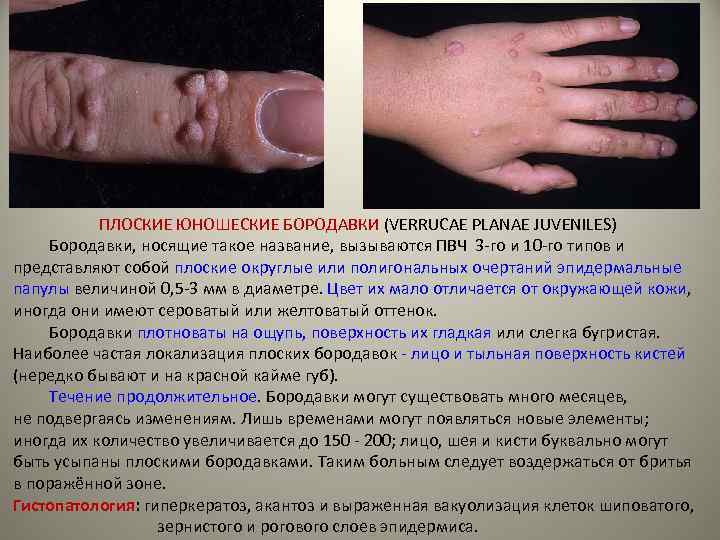 ПЛОСКИЕ ЮНОШЕСКИЕ БОРОДАВКИ (VERRUCAE PLANAE JUVENILES) Бородавки, носящие такое название, вызываются ПВЧ 3 -го