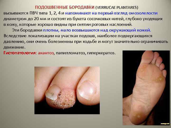 ПОДОШВЕННЫЕ БОРОДАВКИ (VERRUCAE PLANTARES) вызываются ПВЧ типа 1, 2, 4 и напоминают на первый
