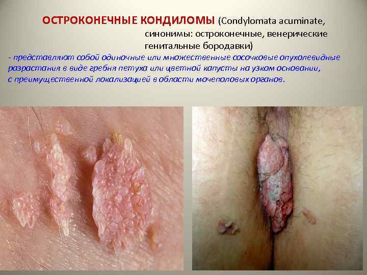 ОСТРОКОНЕЧНЫЕ КОНДИЛОМЫ (Condylomata acuminate, синонимы: остроконечные, венерические генитальные бородавки) - представляют собой одиночные или