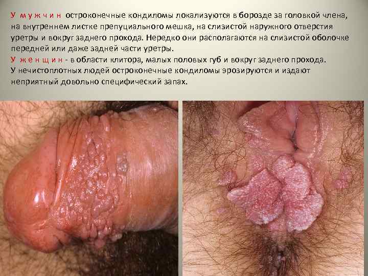 У м у ж ч и н остроконечные кондиломы локализуются в борозде за головкой