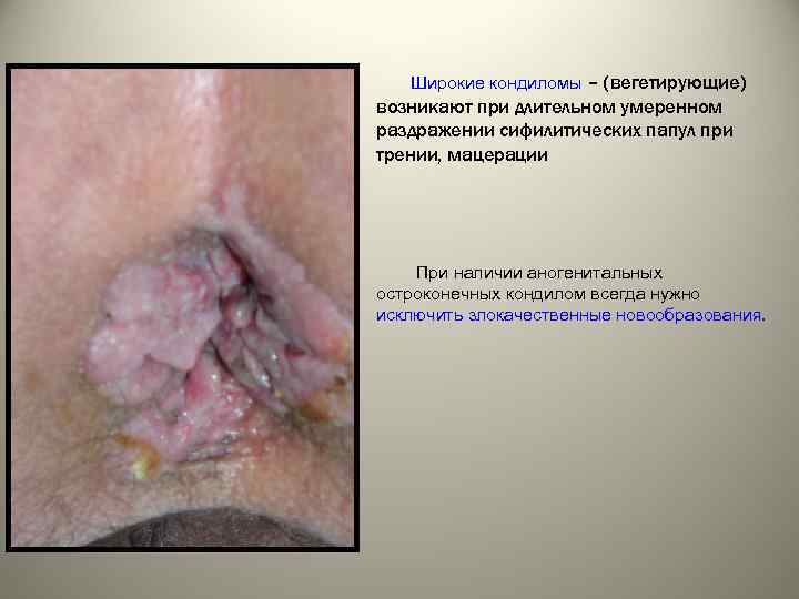 Широкие кондиломы – (вегетирующие) возникают при длительном умеренном раздражении сифилитических папул при трении, мацерации