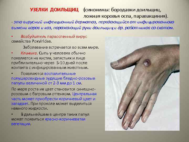 УЗЕЛКИ ДОИЛЬЩИЦ (синонимы: бородавки доильщиц, ложная коровья оспа, паравакциния). - это вирусный инфекционный дерматоз,