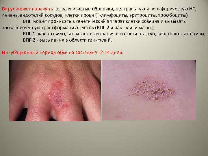 Вирус может поражать кожу, слизистые оболочки, центральную и периферическую НС, печень, эндотелий сосудов, клетки