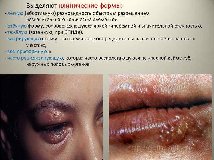 Выделяют клинические формы: - лёгкую (абортивную) разновидность с быстрым разрешением незначительного количества элементов -