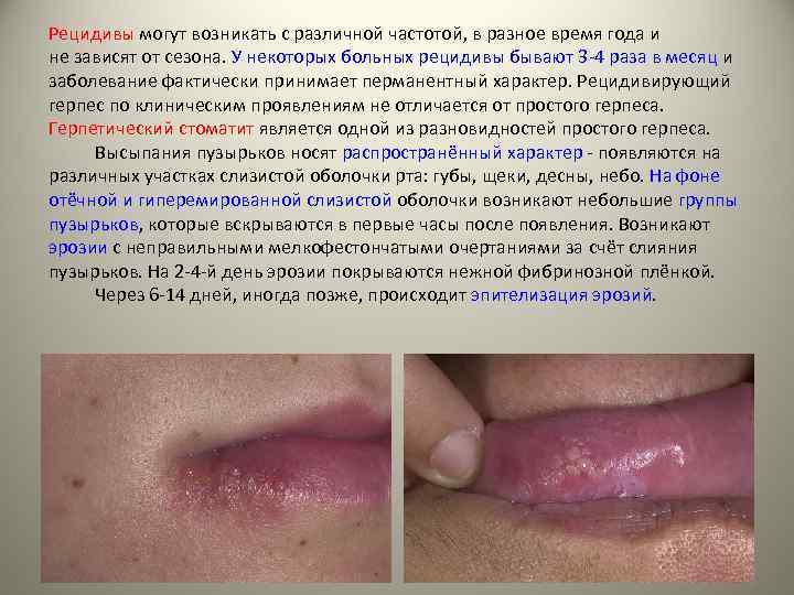 Рецидивы могут возникать с различной частотой, в разное время года и не зависят от