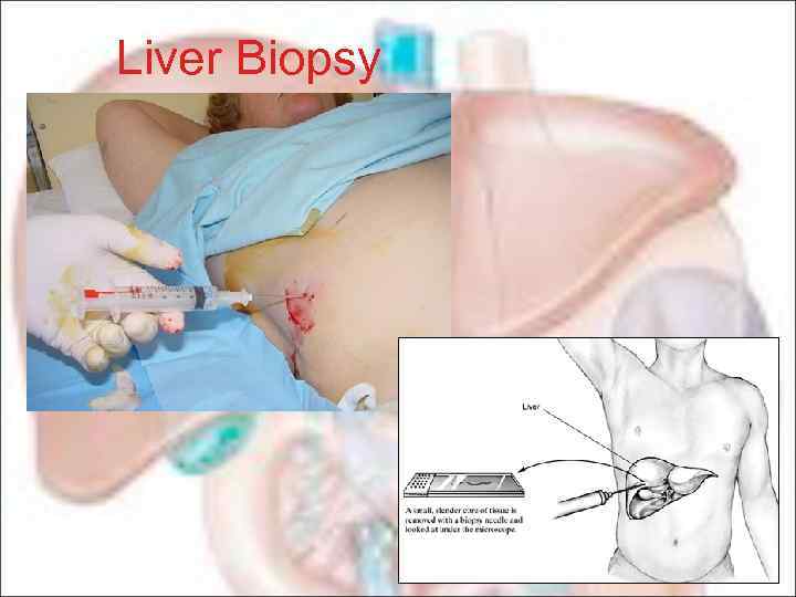 Liver Biopsy 