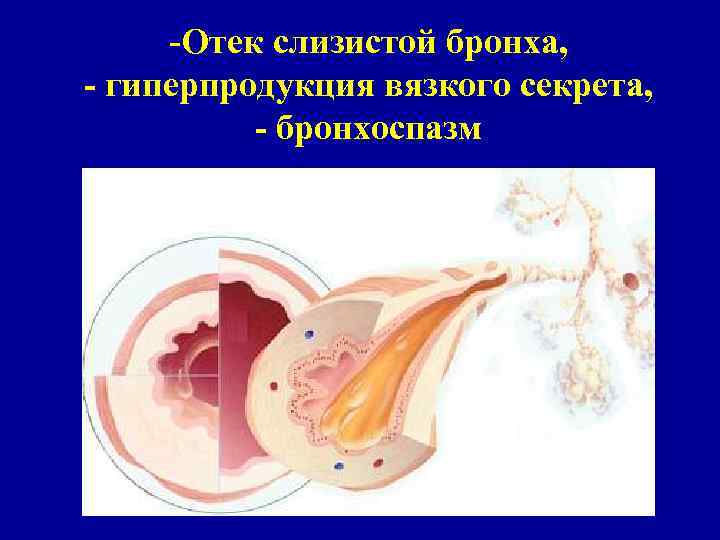 -Отек слизистой бронха, - гиперпродукция вязкого секрета, - бронхоспазм 