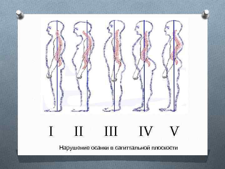 Как называется нарушение осанки изображенное на рисунке 3