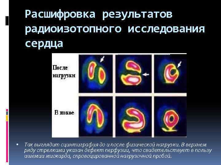 Расшифровка результатов радиоизотопного исследования сердца Так выглядит сцинтиграфия до и после физической нагрузки. В