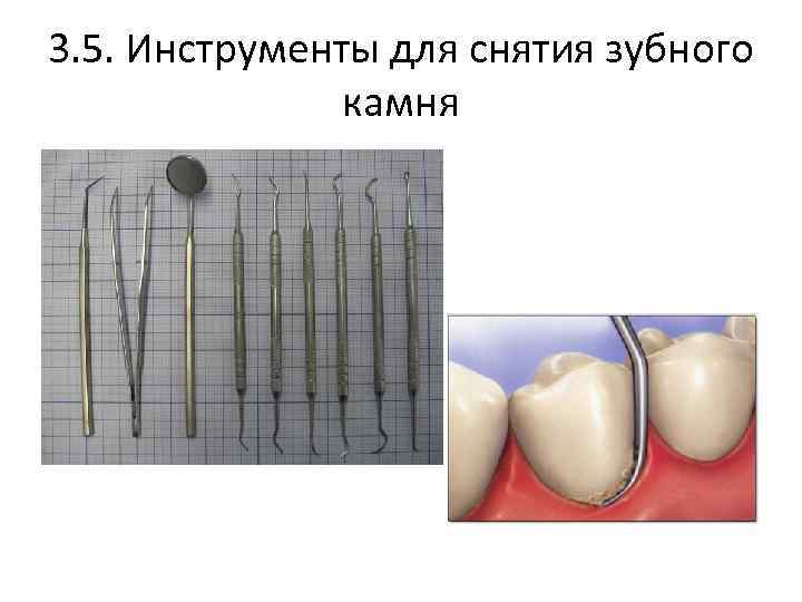 3. 5. Инструменты для снятия зубного камня 