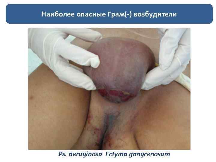 Наиболее опасные Грам(-) возбудители Ps. aeruginosa Ectyma gangrenosum 