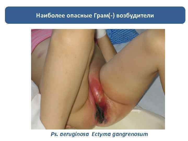 Наиболее опасные Грам(-) возбудители Ps. aeruginosa Ectyma gangrenosum 