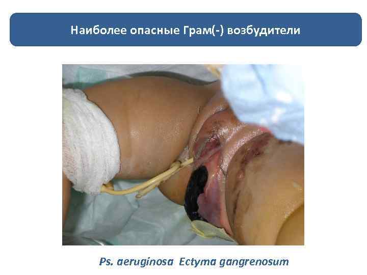 Наиболее опасные Грам(-) возбудители Ps. aeruginosa Ectyma gangrenosum 