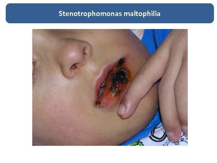 Stenotrophomonas maltophilia 