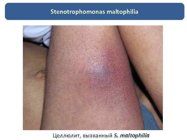 Stenotrophomonas maltophilia Целлюлит, вызванный S. maltophilia 