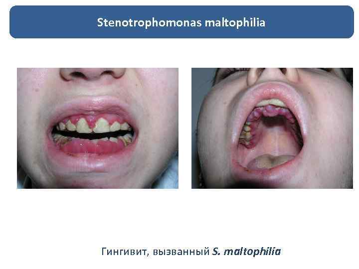 Stenotrophomonas maltophilia Гингивит, вызванный S. maltophilia 