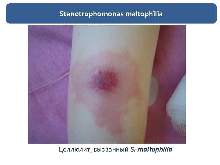 Stenotrophomonas maltophilia Целлюлит, вызванный S. maltophilia 