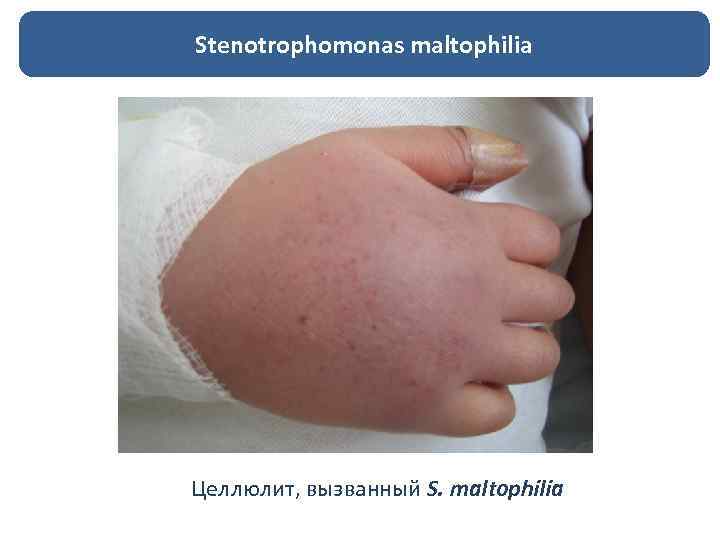 Stenotrophomonas maltophilia Целлюлит, вызванный S. maltophilia 