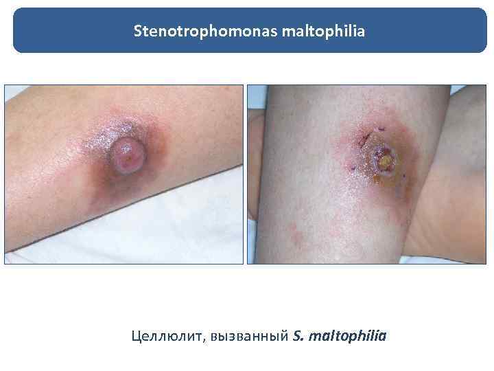 Stenotrophomonas maltophilia Целлюлит, вызванный S. maltophilia 