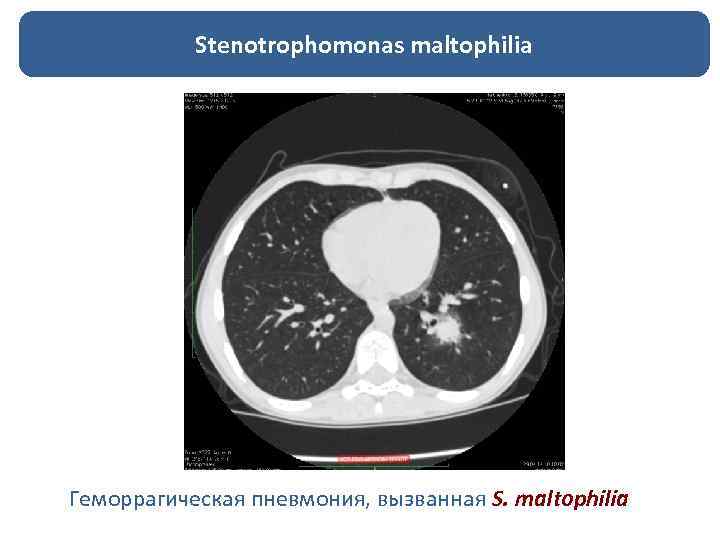 Stenotrophomonas maltophilia Геморрагическая пневмония, вызванная S. maltophilia 