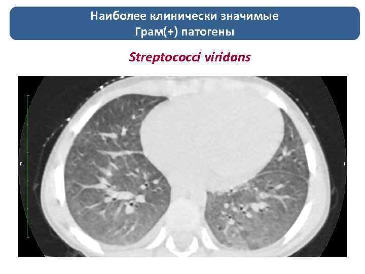 Наиболее клинически значимые Грам(+) патогены Streptococci viridans 