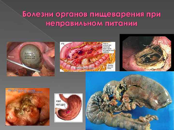 Болезни органов пищеварения при неправильном питании 