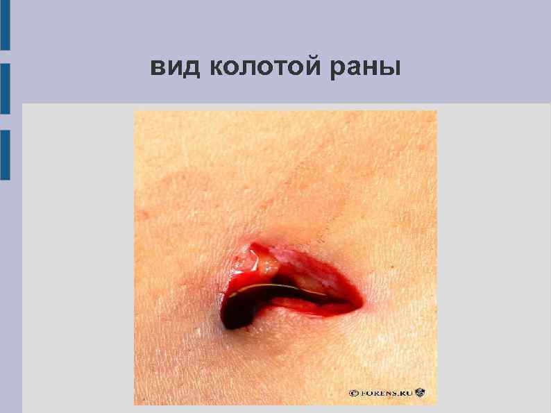 вид колотой раны 