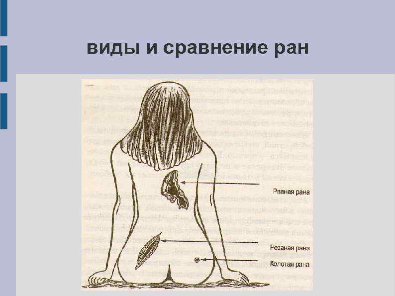 виды и сравнение ран 