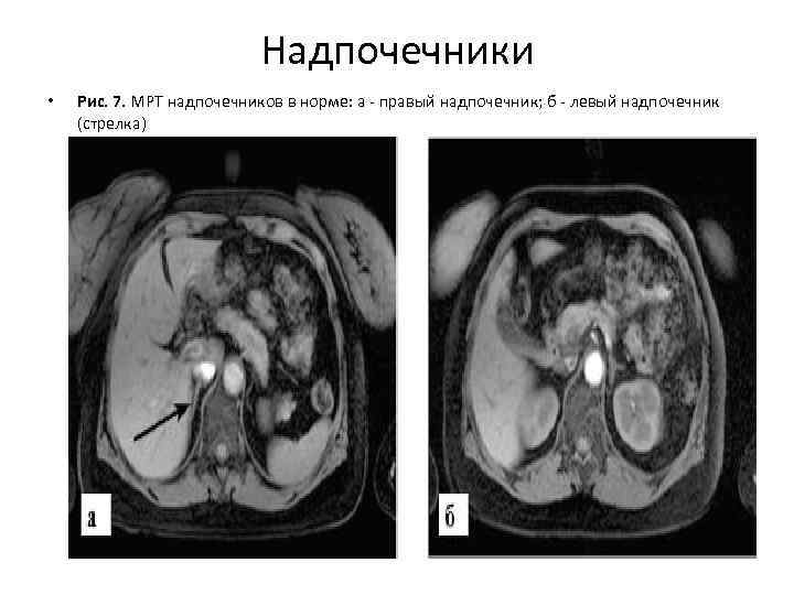Мрт 7. Мрт надпочечников норма. Надпочечники мрт анатомия. Мрт надпочечников описание.