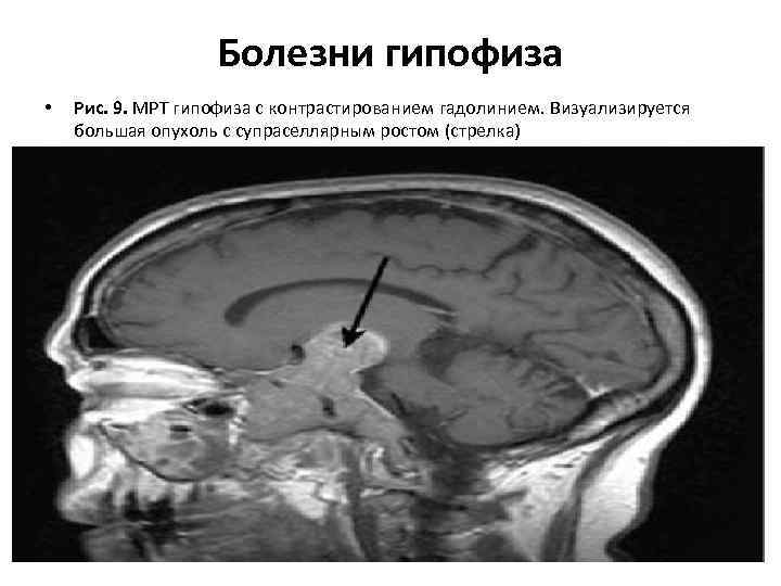 Мрт 9. Гипофиз интраселлярно. Инфраселлярный рост аденомы гипофиза. Гипофиз супраселлярный рост опухоли. Супраселлярное распространение аденомы гипофиза.