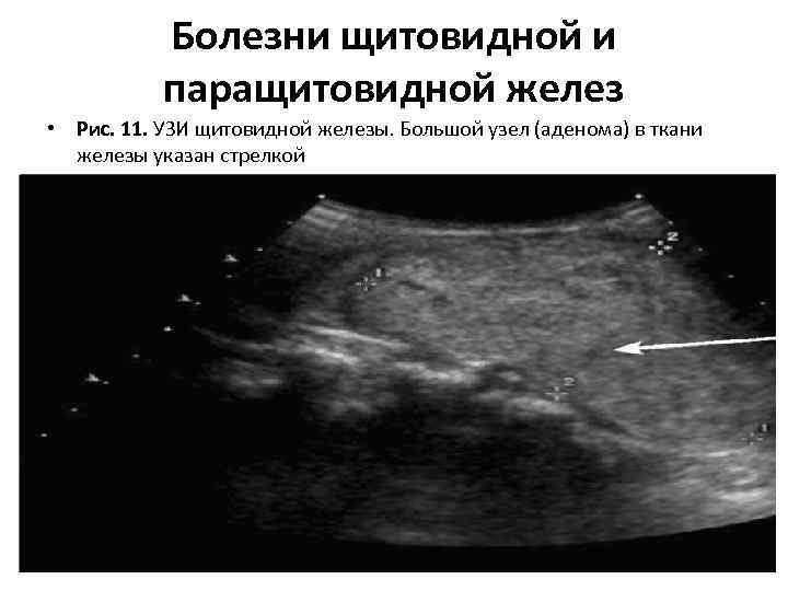 Ультразвуковое исследование паращитовидной железы