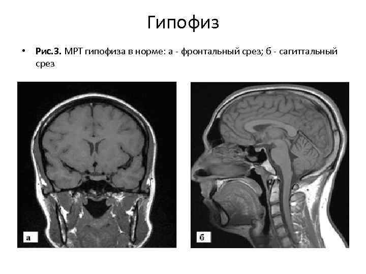 Мр картина диффузно неоднородной структуры гипофиза