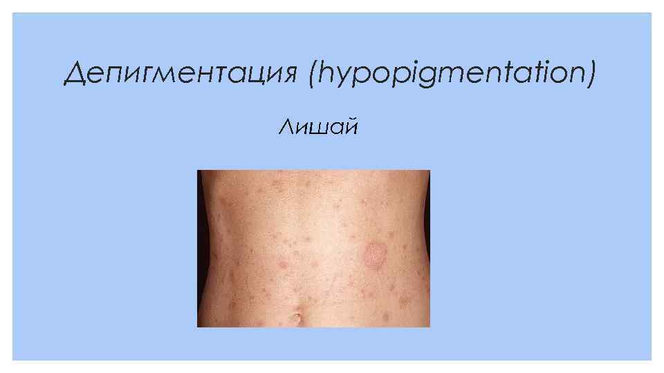 Депигментация (hypopigmentation) Лишай 