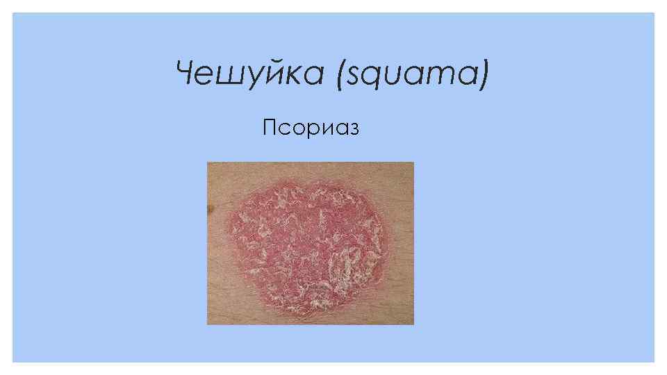 Чешуйка (squama) Псориаз 