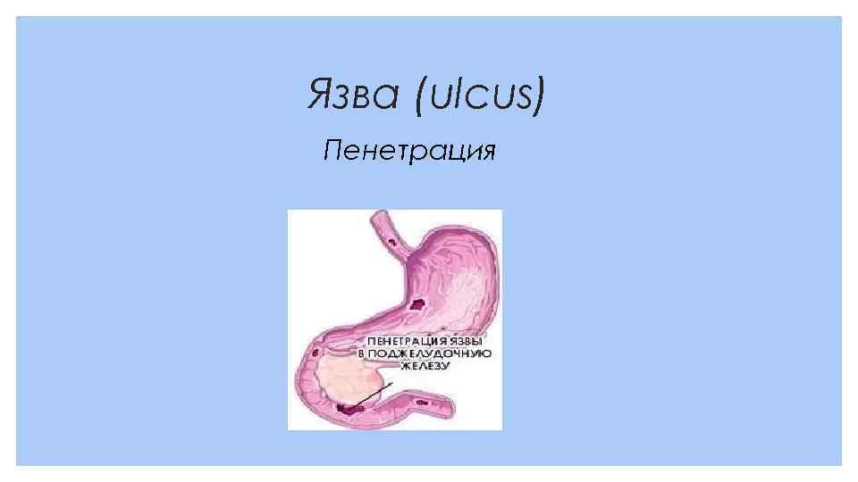 Язва (ulcus) Пенетрация 