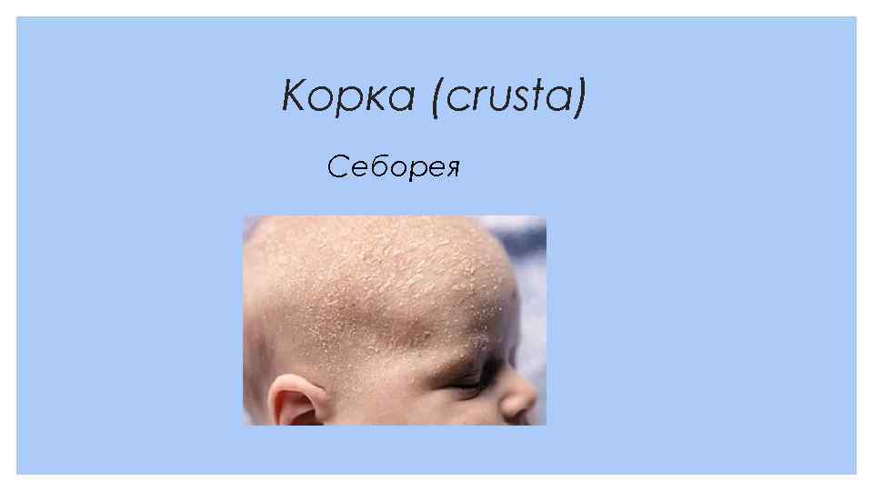 Корка (crusta) Себорея 