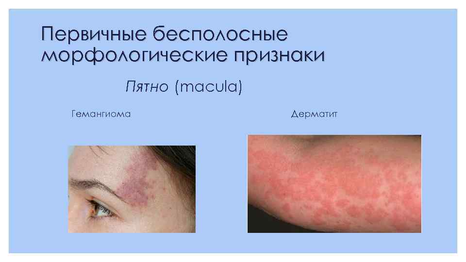 Первичные бесполосные морфологические признаки Пятно (macula) Гемангиома Дерматит 