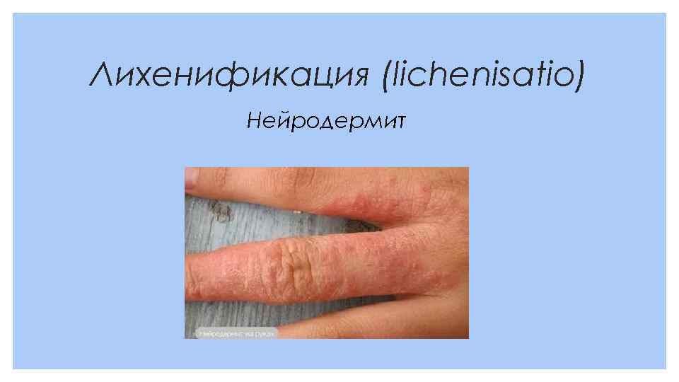 Лихенификация (lichenisatio) Нейродермит 