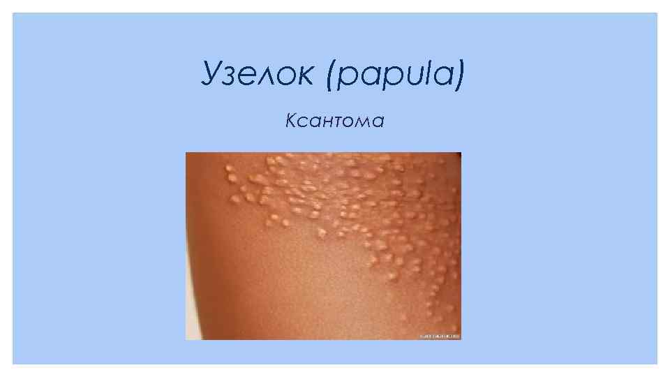 Узелок (papula) Ксантома 