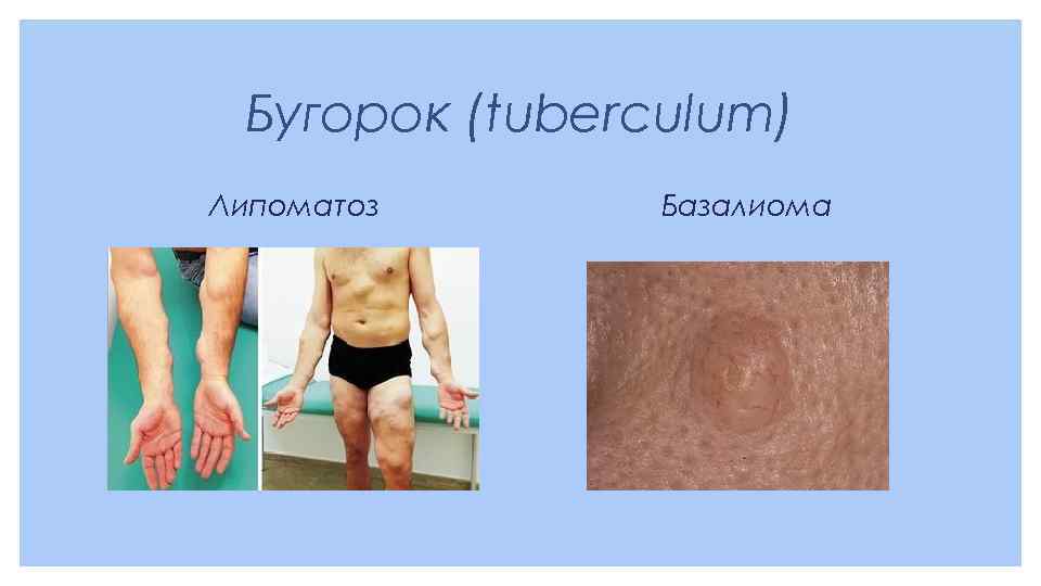 Бугорок (tuberculum) Липоматоз Базалиома 