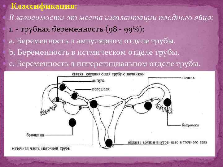 Эктопическая беременность презентация