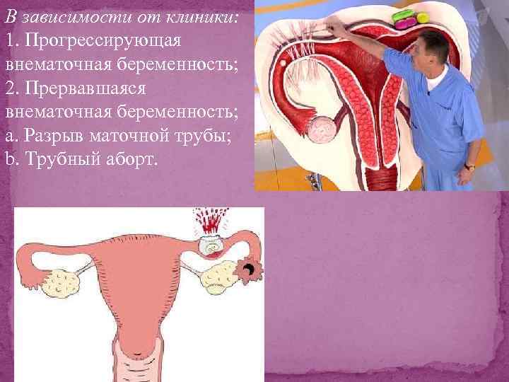 В зависимости от клиники: 1. Прогрессирующая внематочная беременность; 2. Прервавшаяся внематочная беременность; а. Разрыв
